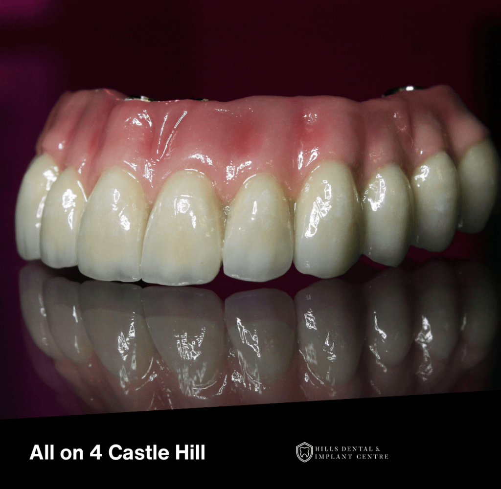 All on 4 Dental Implants Castle Hill