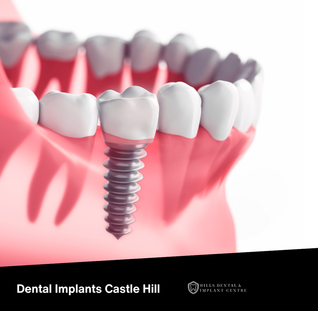 Dental Implants Castle Hill