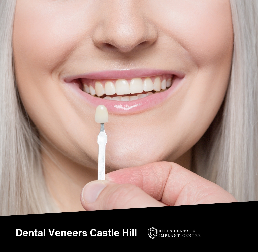 dental veneers castle hill