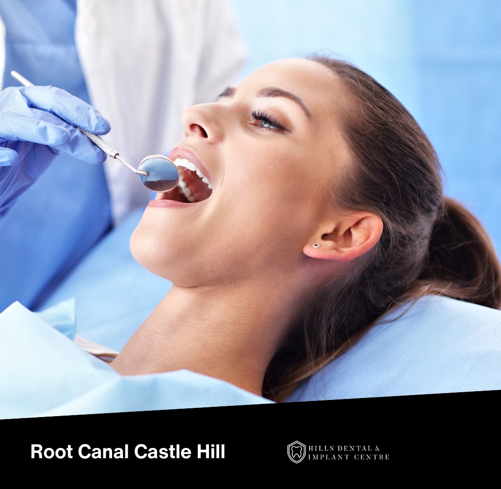 root canal castle hill