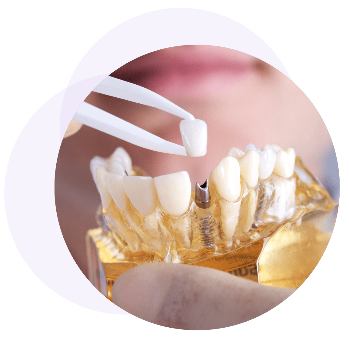 Types of Dental Implants in Castle Hill