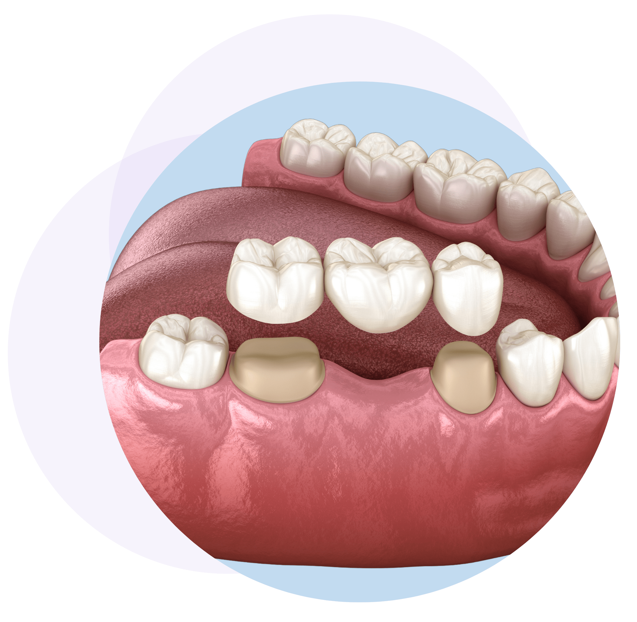 What Are Dental Bridges
