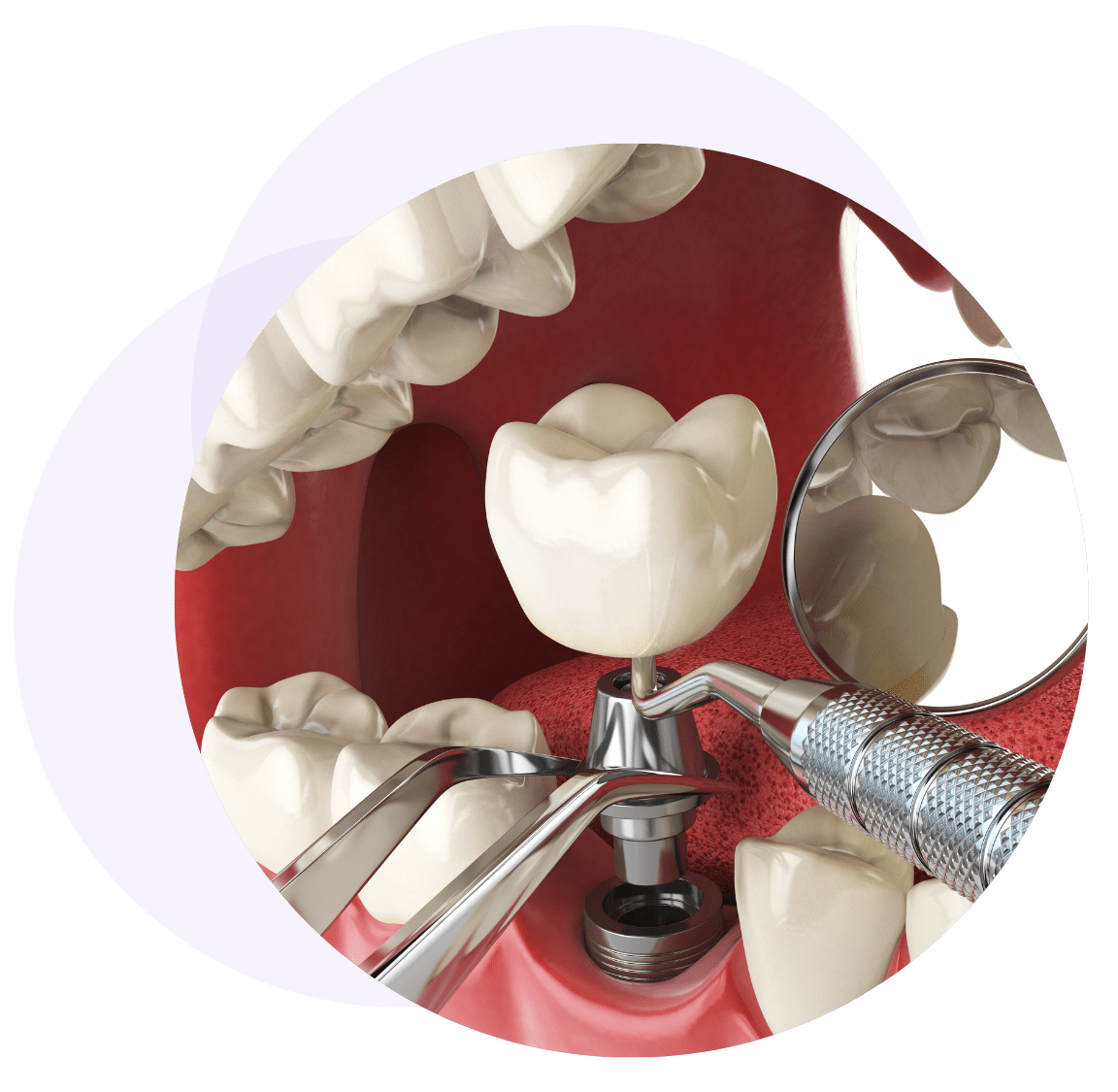 Visualisation of Dental Implants Components being installed all at once