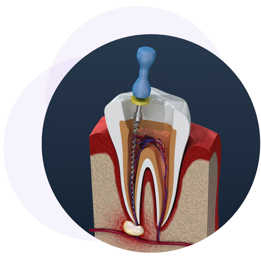 when do you need a root canal 01