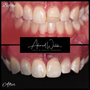 affordable single dental implant