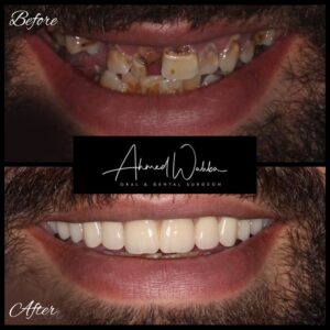 after dental implant treatment