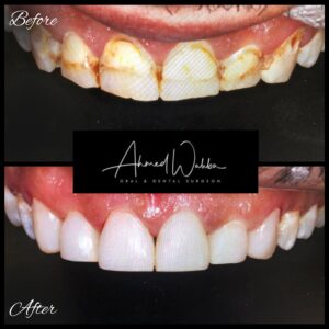 after full mouth dental implants