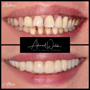 all on 4 dental implants