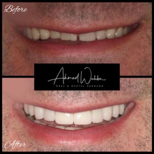 before after cosmetic dentistry