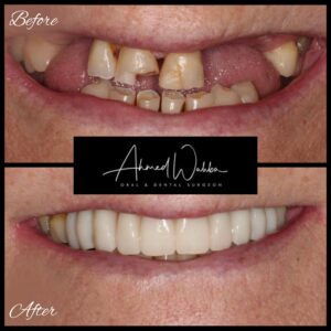 before after dental implants procedure