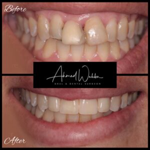 before and after dental implant procedure