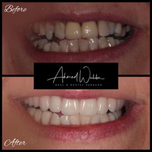 multiple dental implants results