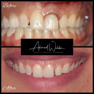 single dental implant